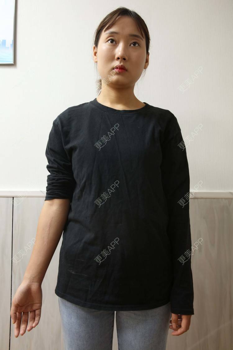 更美 - 更美用户ExkBwQQ9EM的经验 | 综合淡疤 | 手术淡疤 | 激光淡疤 | 成都