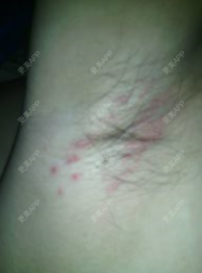 更美 - 更美用户kd3qpAyZgz的手术除腋臭经验 | 手术除腋臭