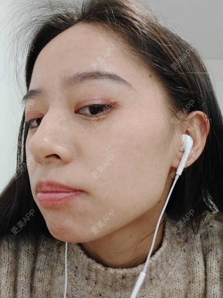 更美 - 更美用户FKgNeqD2Py的黑脸娃娃经验 | 光子嫩肤 | 白瓷娃娃 | 黑脸娃娃 | 彩光嫩肤 | 美白套餐 | 重庆 | 点阵激光 | 注射美白 | 镭射净肤 | 果酸焕肤 | 激光淡斑