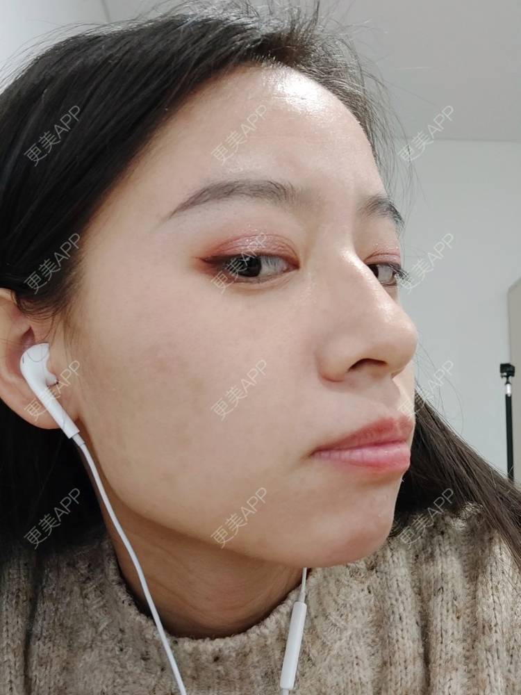 更美 - 更美用户FKgNeqD2Py的黑脸娃娃经验 | 光子嫩肤 | 白瓷娃娃 | 黑脸娃娃 | 彩光嫩肤 | 美白套餐 | 重庆 | 点阵激光 | 注射美白 | 镭射净肤 | 果酸焕肤 | 激光淡斑