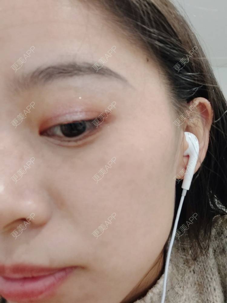 更美 - 更美用户FKgNeqD2Py的黑脸娃娃经验 | 光子嫩肤 | 白瓷娃娃 | 黑脸娃娃 | 彩光嫩肤 | 美白套餐 | 重庆 | 点阵激光 | 注射美白 | 镭射净肤 | 果酸焕肤 | 激光淡斑
