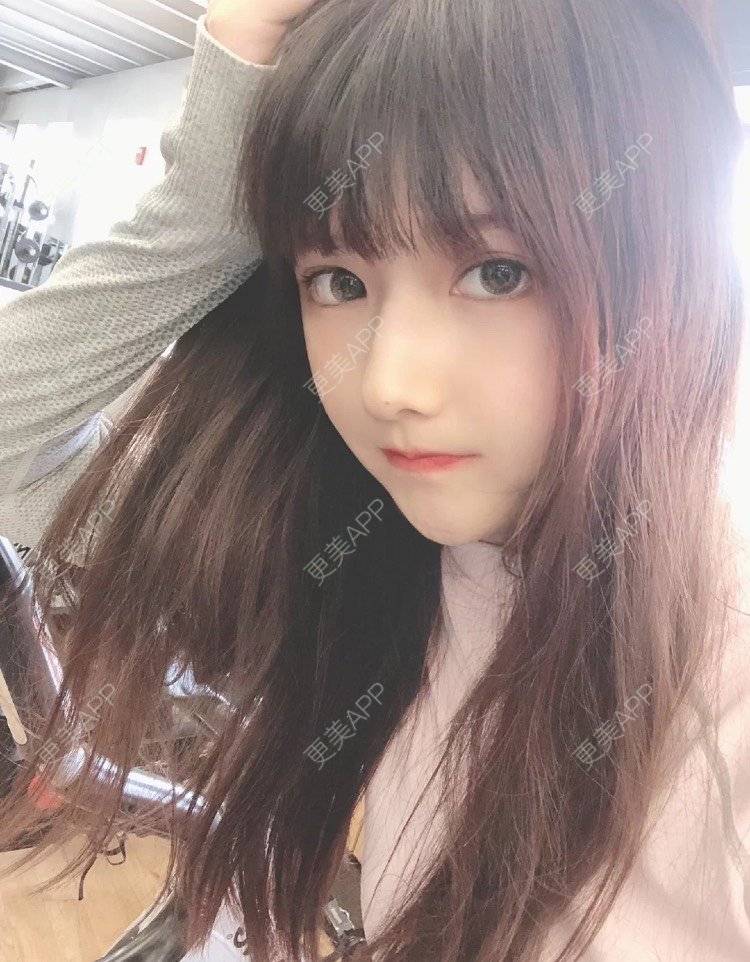 更美 - 婉青儿的凸嘴矫正经验 | 广州 | 凸嘴矫正 | 面部不对称矫正