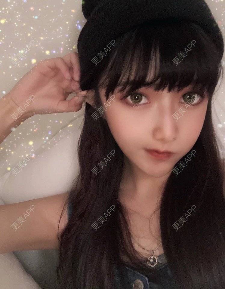更美 - 婉青儿的凸嘴矫正经验 | 广州 | 凸嘴矫正 | 面部不对称矫正