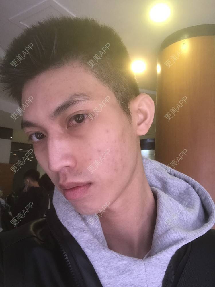 更美 - 博一男神的水杨酸焕肤经验 | 水杨酸焕肤