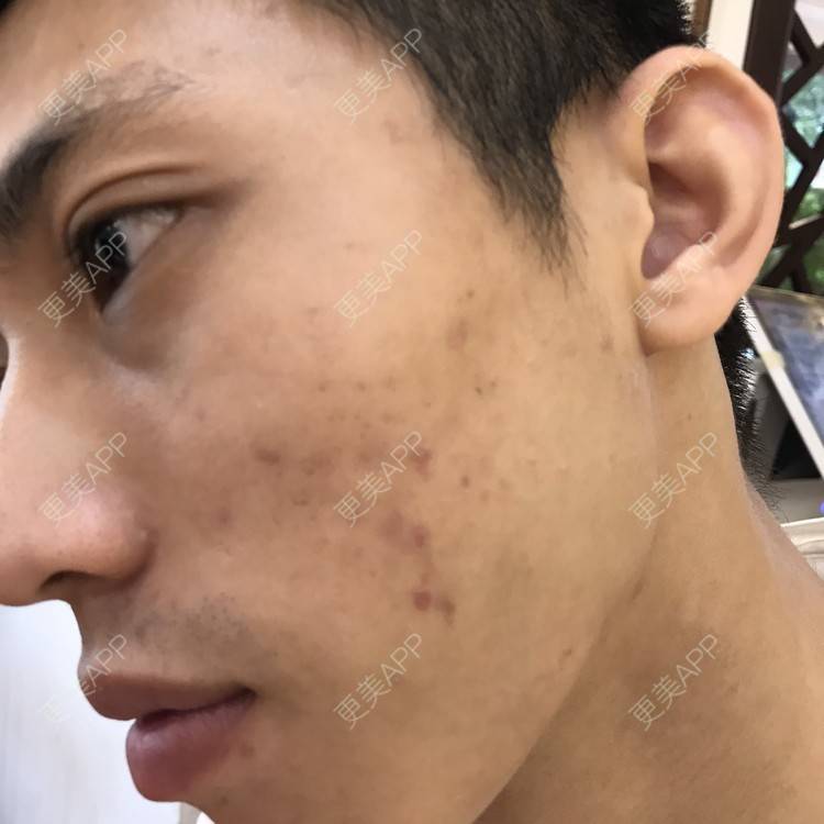 更美 - 博一男神的水杨酸焕肤经验 | 水杨酸焕肤