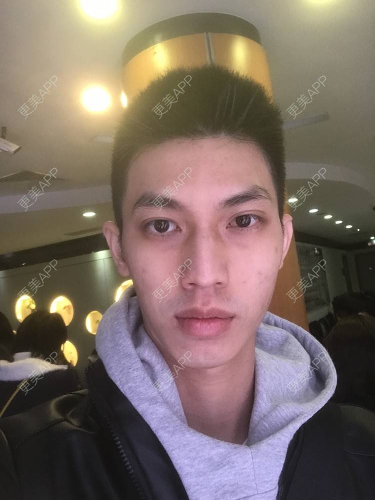 更美 - 博一男神的水杨酸焕肤经验 | 水杨酸焕肤