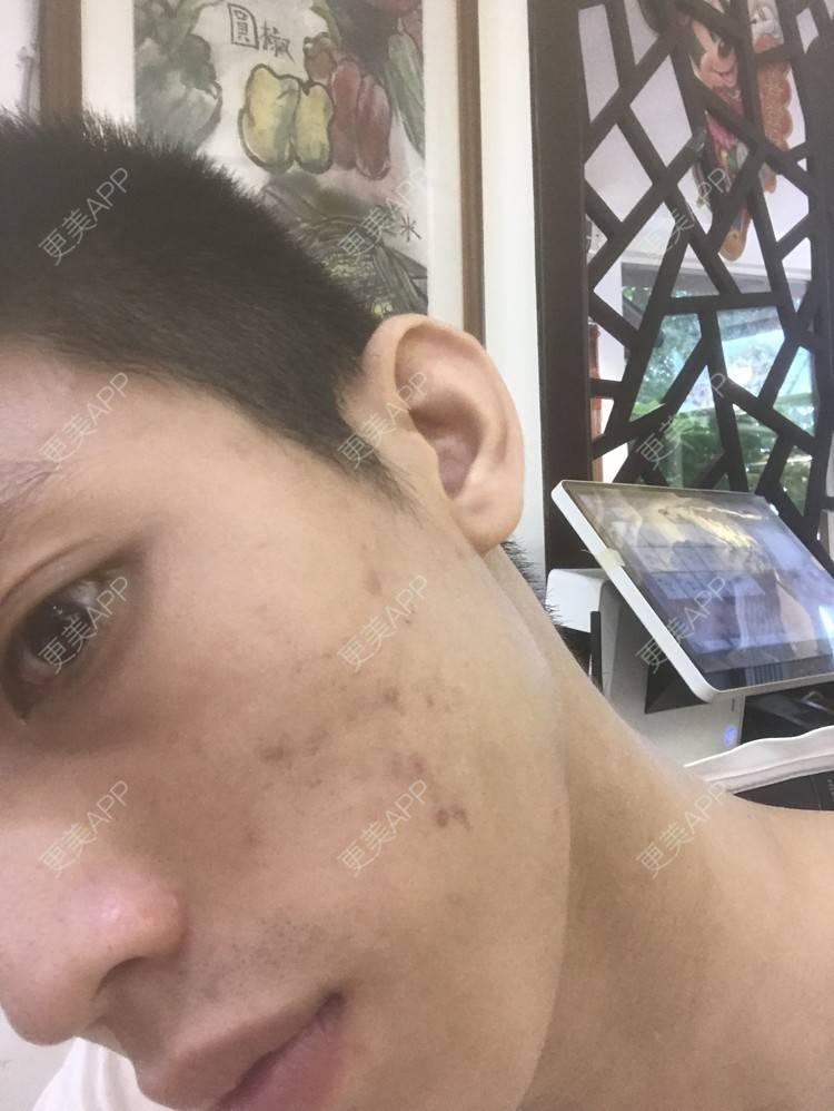 更美 - 博一男神的水杨酸焕肤经验 | 水杨酸焕肤