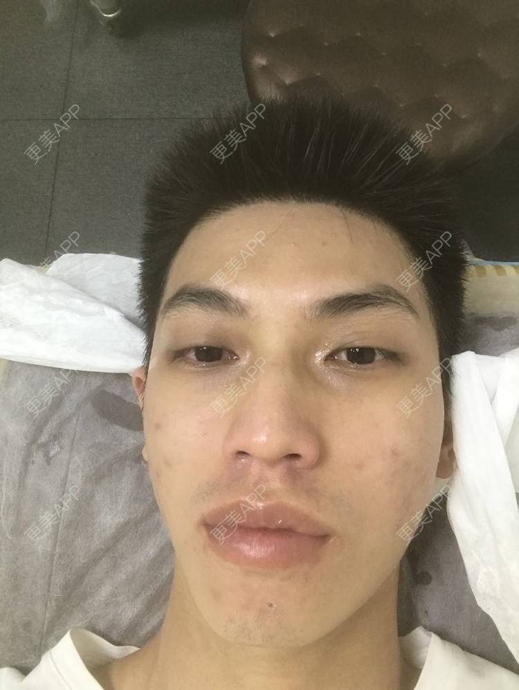 更美 - 博一男神的水杨酸焕肤经验 | 水杨酸焕肤