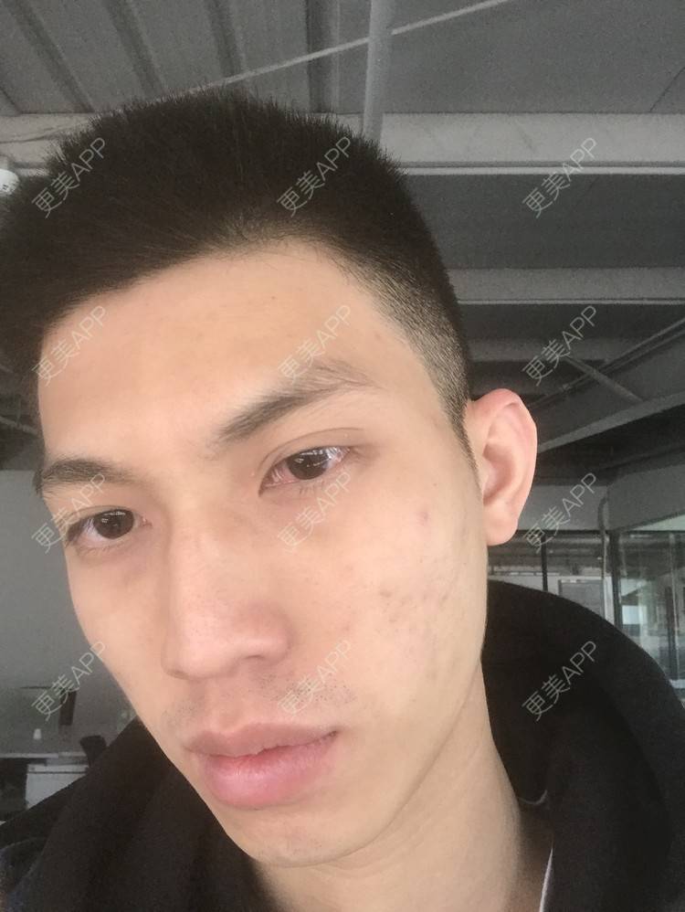 更美 - 博一男神的水杨酸焕肤经验 | 水杨酸焕肤