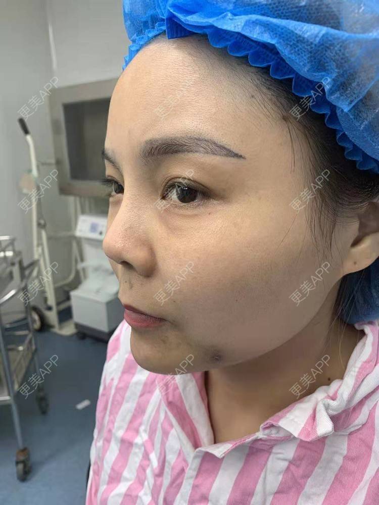 更美 - 更美用户PVvylmTjJA的自体脂肪全面部填充经验 | 长沙 | 自体脂肪全面部填充