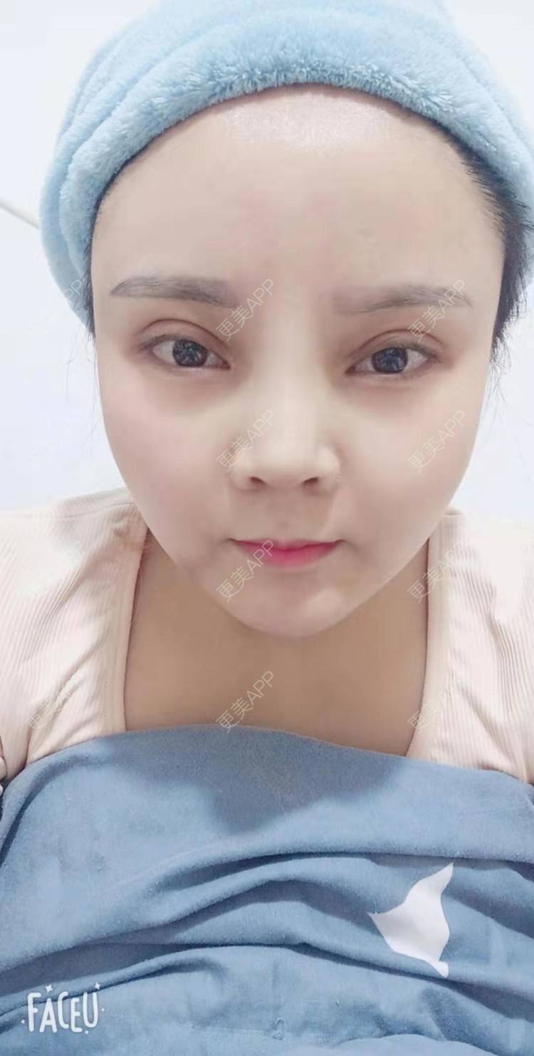 更美 - 更美用户PVvylmTjJA的自体脂肪全面部填充经验 | 长沙 | 自体脂肪全面部填充