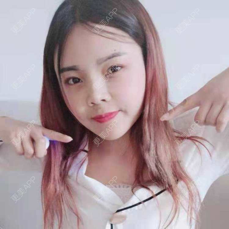 更美 - 更美用户PVvylmTjJA的自体脂肪全面部填充经验 | 长沙 | 自体脂肪全面部填充