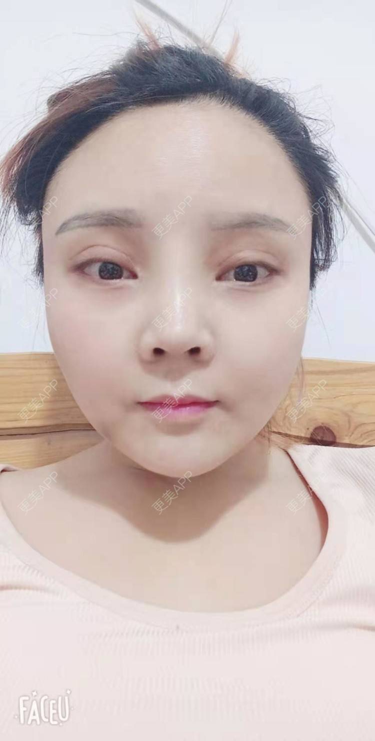 更美 - 更美用户PVvylmTjJA的自体脂肪全面部填充经验 | 长沙 | 自体脂肪全面部填充