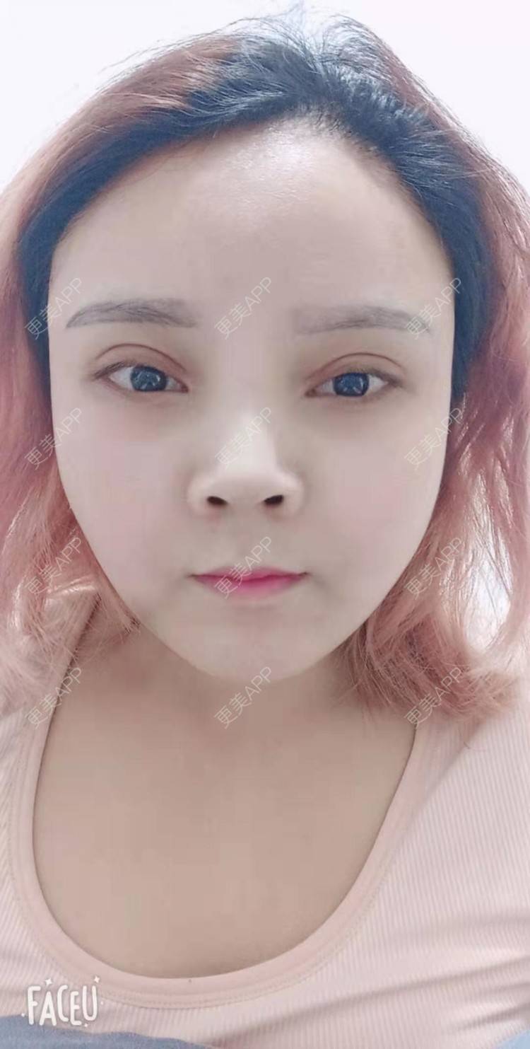 更美 - 更美用户PVvylmTjJA的自体脂肪全面部填充经验 | 长沙 | 自体脂肪全面部填充