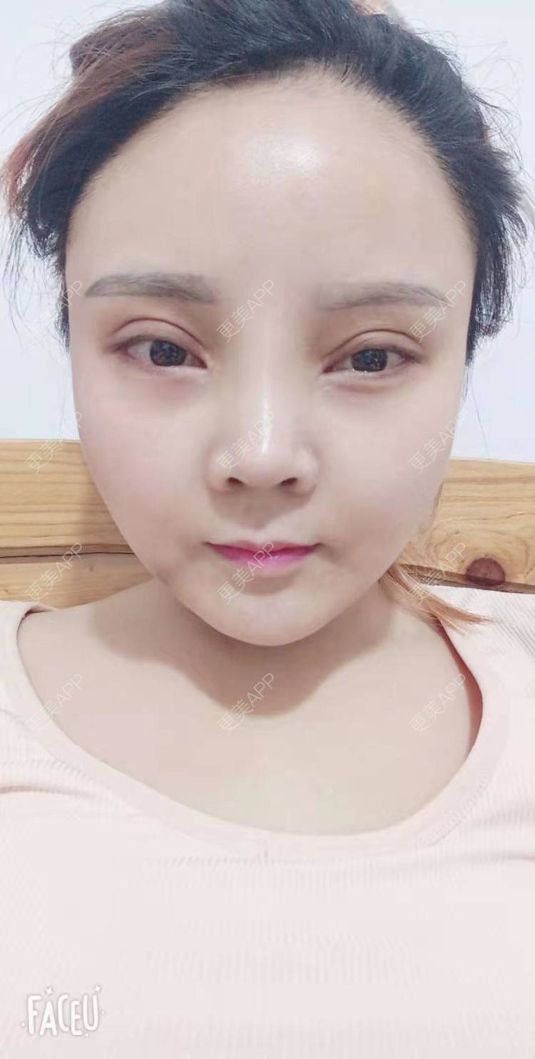 更美 - 更美用户PVvylmTjJA的自体脂肪全面部填充经验 | 长沙 | 自体脂肪全面部填充