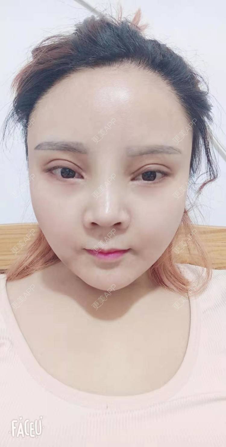 更美 - 更美用户PVvylmTjJA的自体脂肪全面部填充经验 | 长沙 | 自体脂肪全面部填充