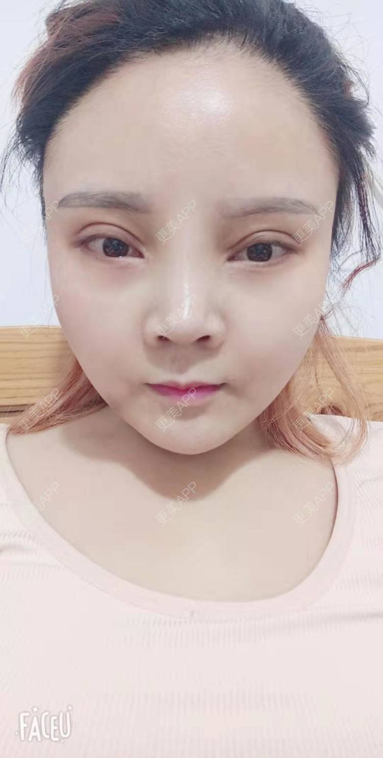 更美 - 更美用户PVvylmTjJA的自体脂肪全面部填充经验 | 长沙 | 自体脂肪全面部填充