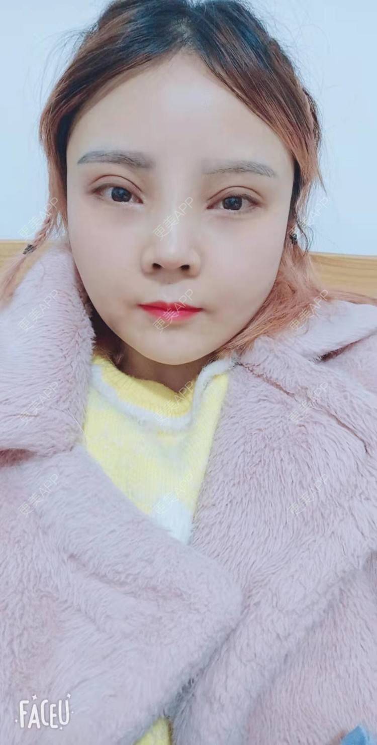 更美 - 更美用户PVvylmTjJA的手臂吸脂经验 | 手臂吸脂 | 长沙