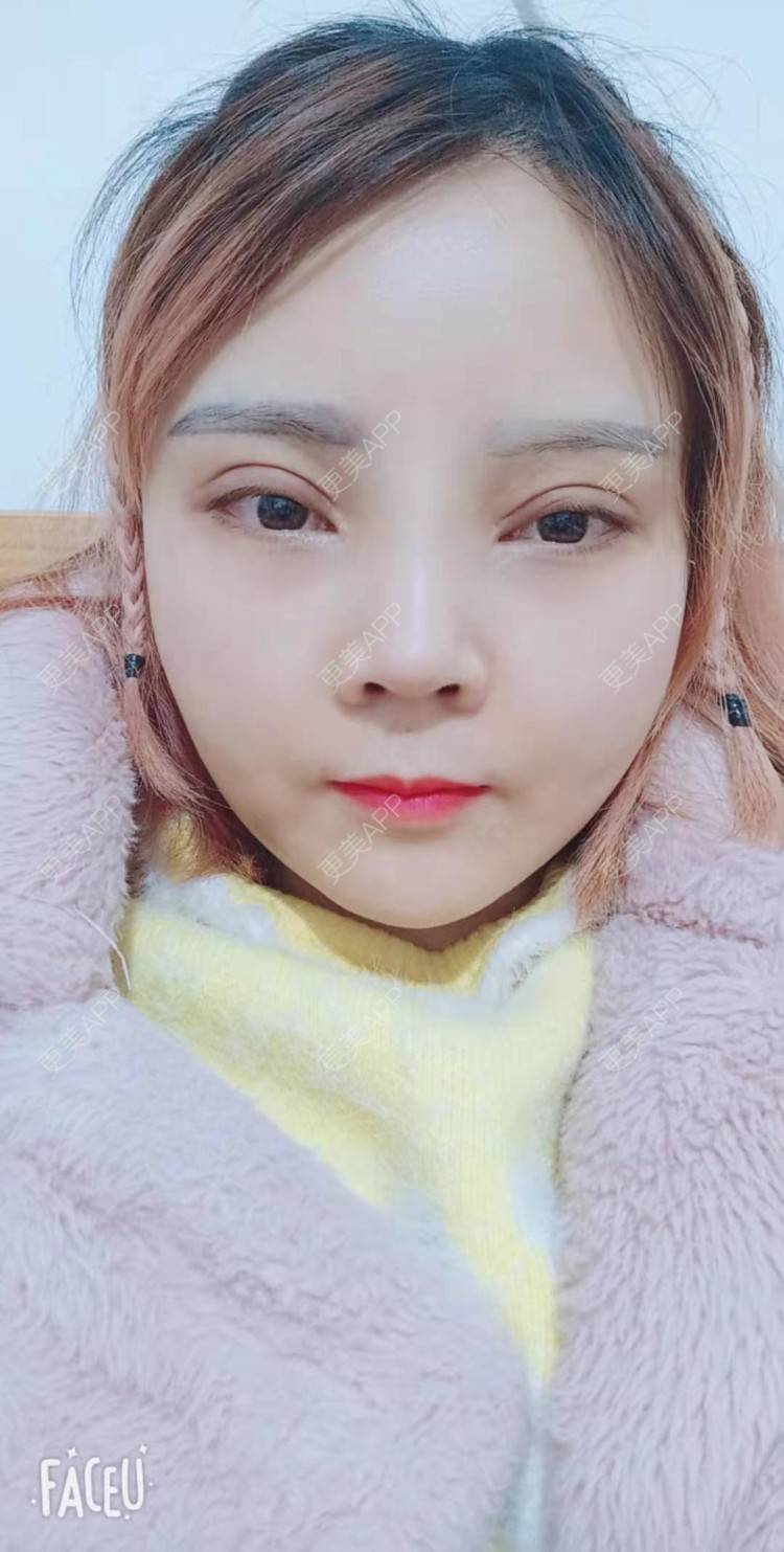 更美 - 更美用户PVvylmTjJA的手臂吸脂经验 | 手臂吸脂 | 长沙