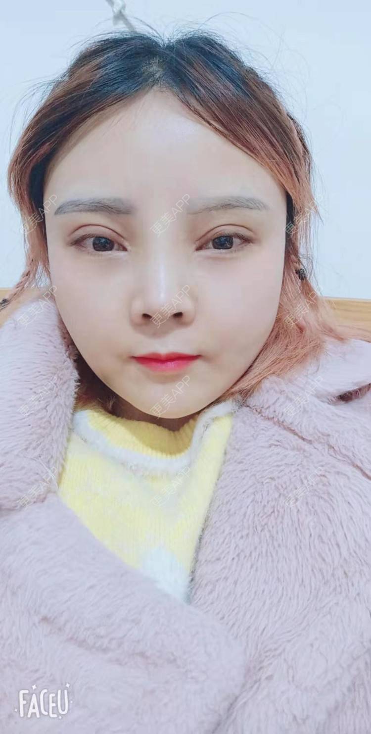 更美 - 更美用户PVvylmTjJA的手臂吸脂经验 | 手臂吸脂 | 长沙
