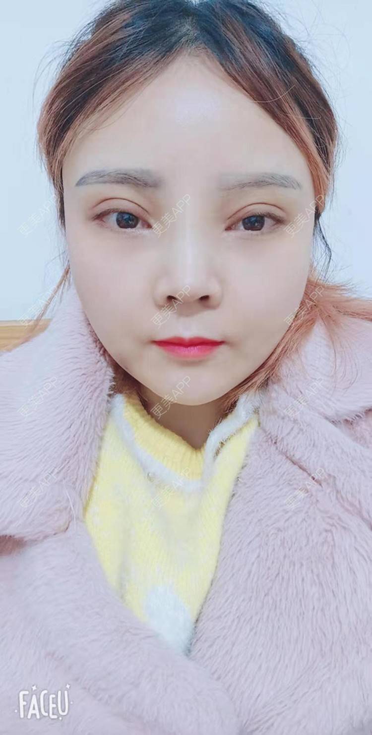 更美 - 更美用户PVvylmTjJA的手臂吸脂经验 | 手臂吸脂 | 长沙