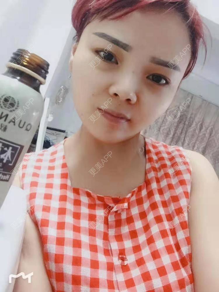 更美 - 更美用户PVvylmTjJA的手臂吸脂经验 | 手臂吸脂 | 长沙