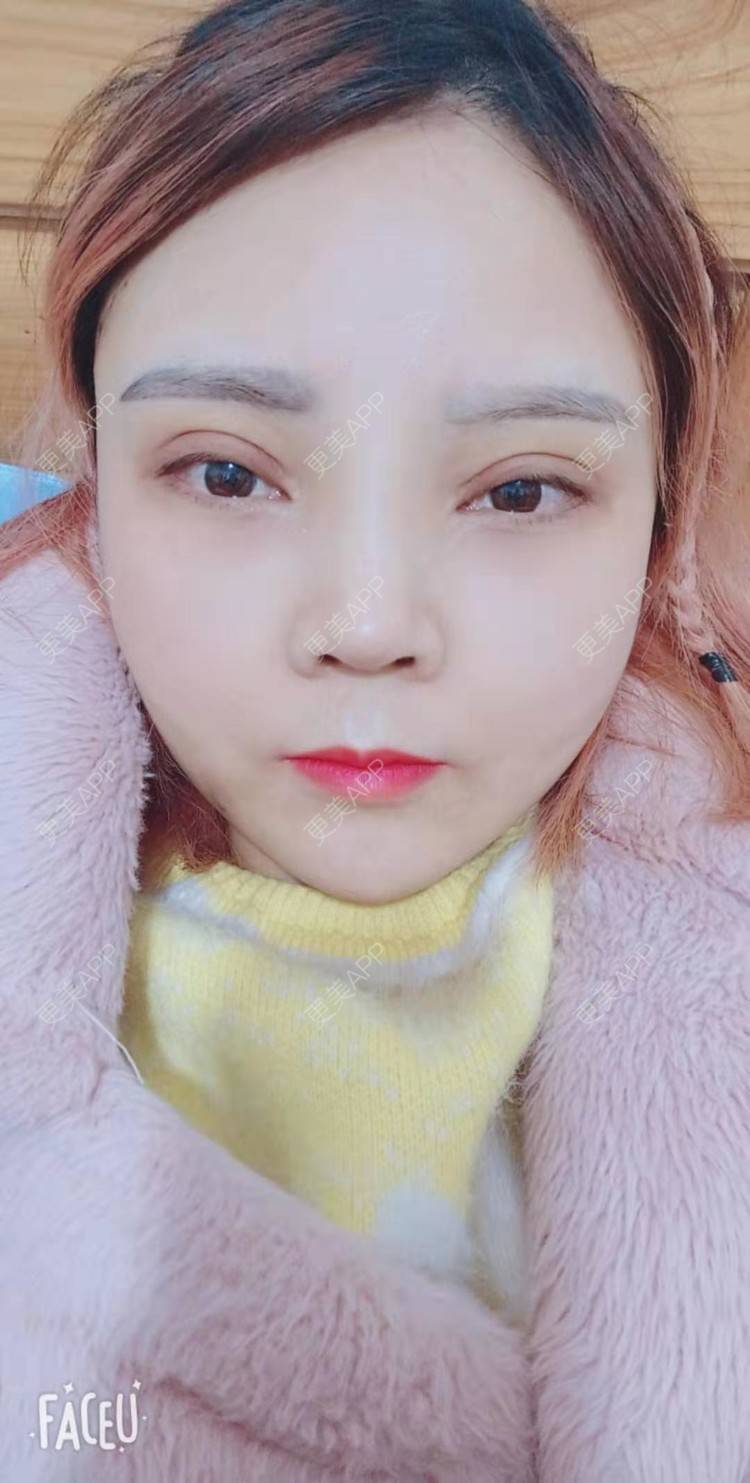 更美 - 更美用户PVvylmTjJA的手臂吸脂经验 | 手臂吸脂 | 长沙