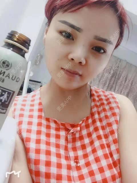 更美 - 更美用户PVvylmTjJA的手臂吸脂经验 | 手臂吸脂 | 长沙