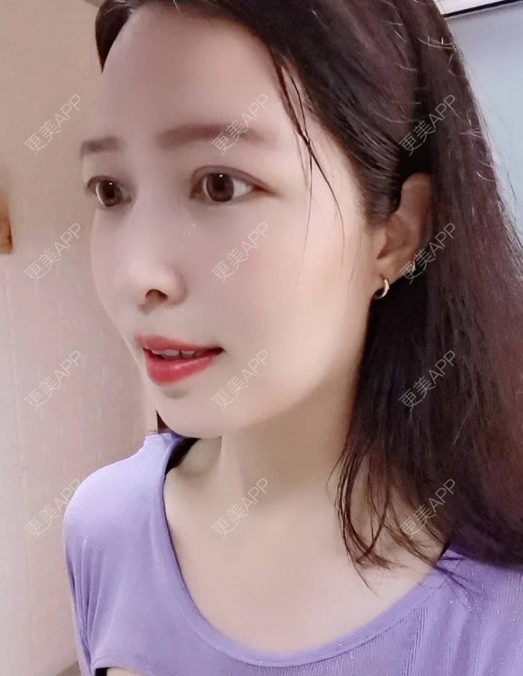 更美 - 更美用户uJDPRcUYHR的凸嘴矫正经验 | 广州 | 凸嘴矫正