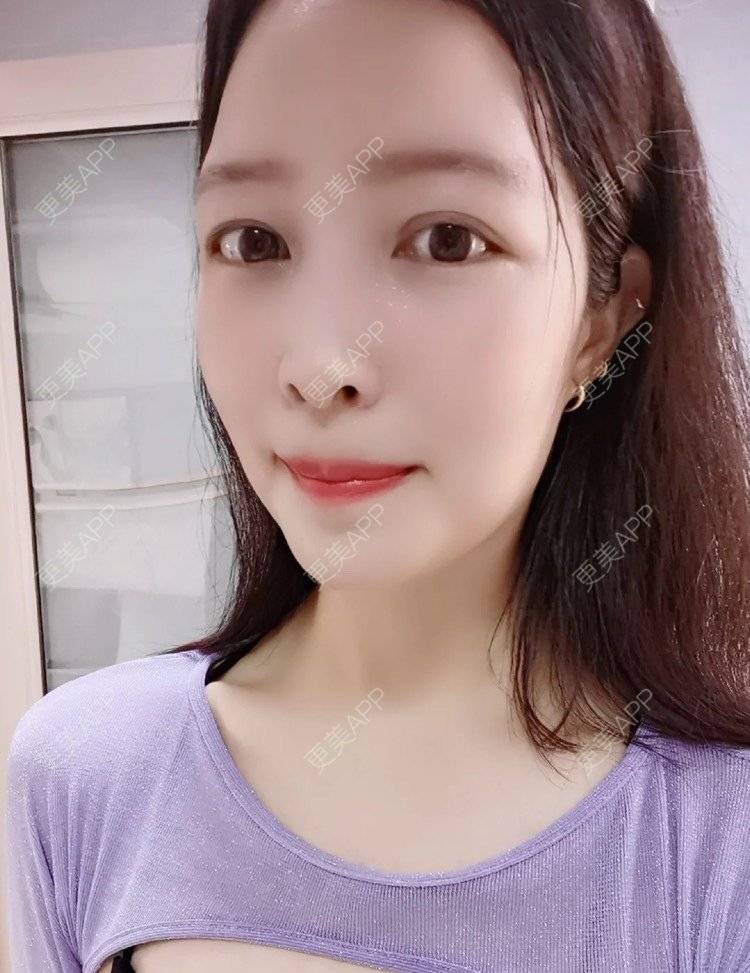 更美 - 更美用户uJDPRcUYHR的凸嘴矫正经验 | 广州 | 凸嘴矫正