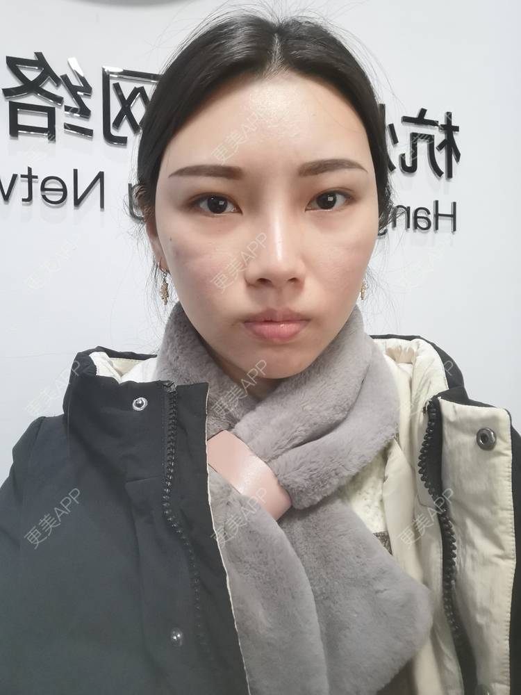 更美 - 更美用户82701801的隐形牙齿矫正经验 | 杭州