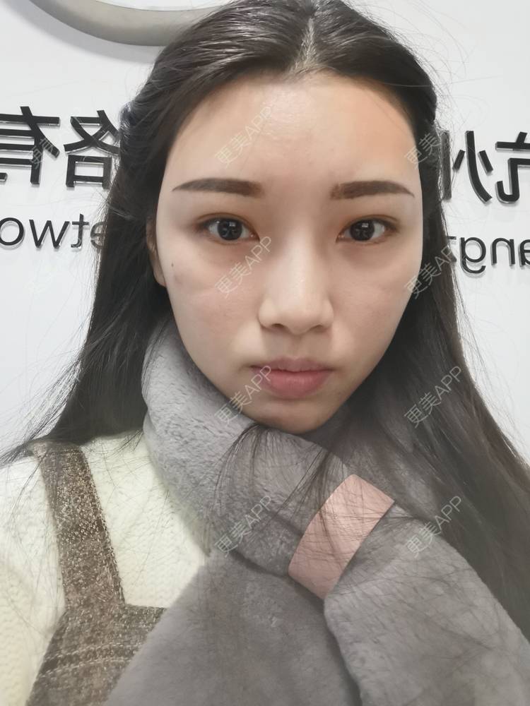 更美 - 更美用户82701801的隐形牙齿矫正经验 | 杭州