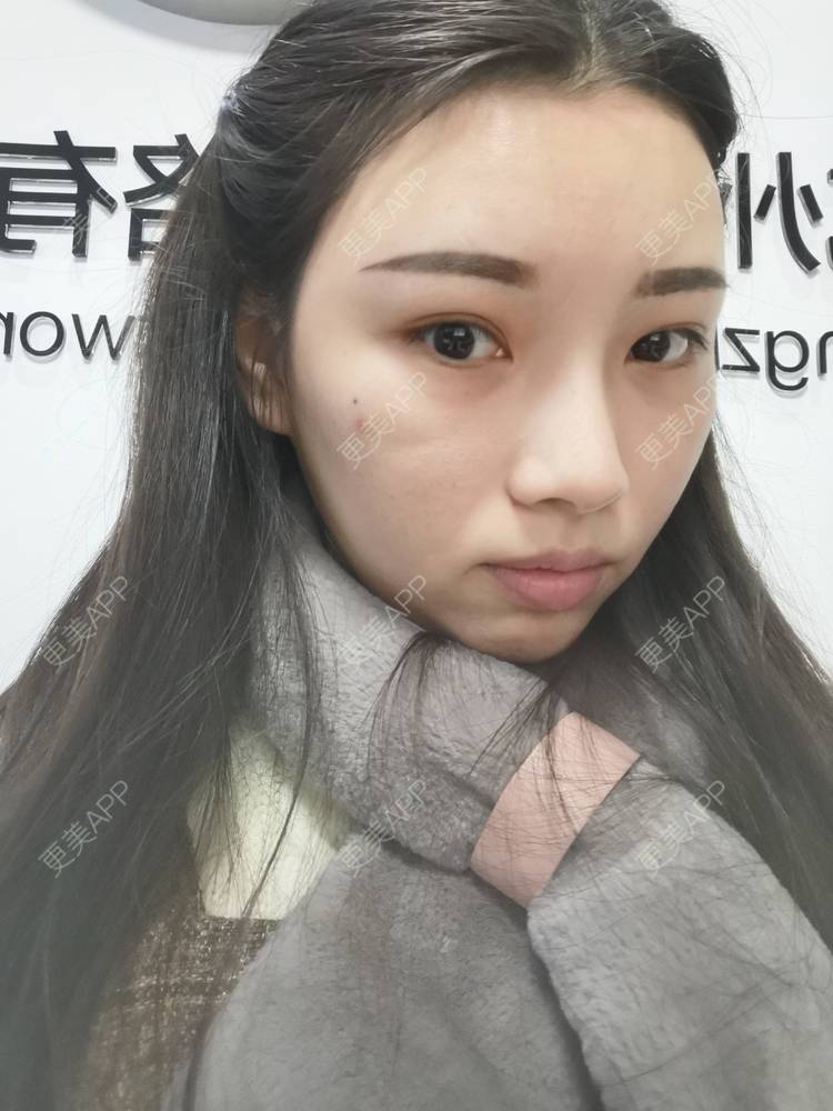 更美 - 更美用户82701801的隐形牙齿矫正经验 | 杭州