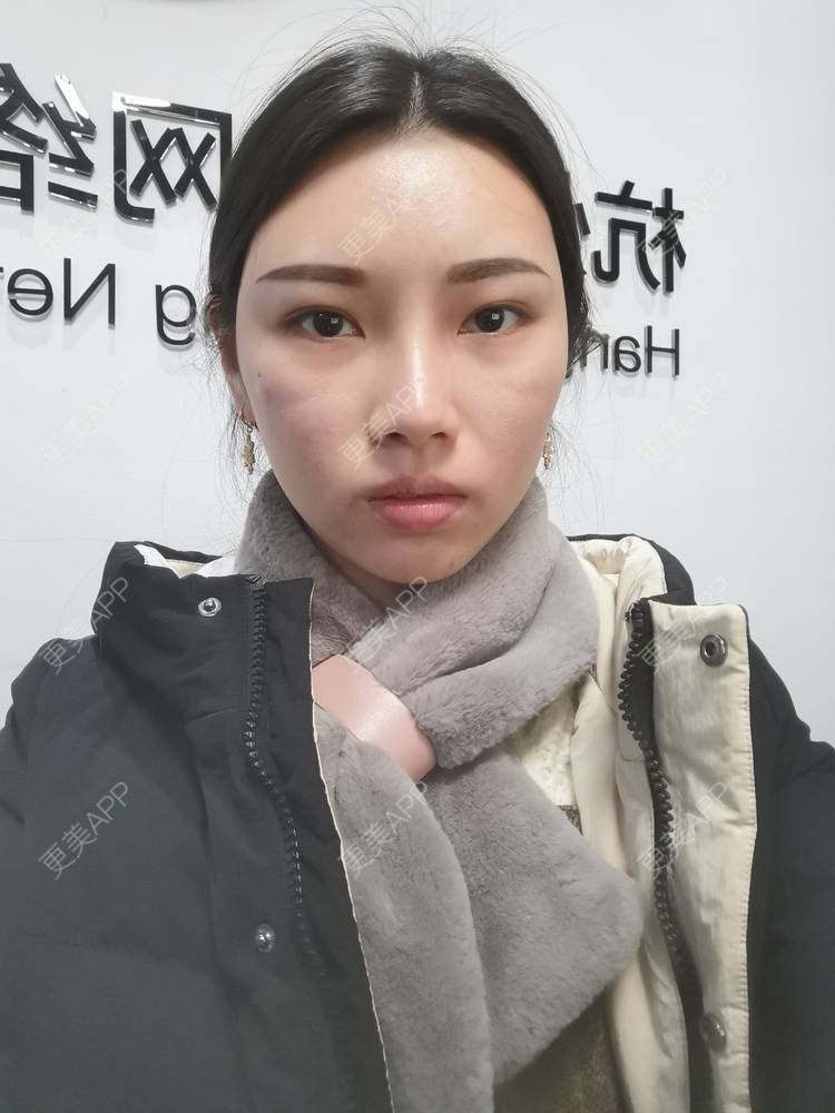 更美 - 更美用户82701801的隐形牙齿矫正经验 | 杭州