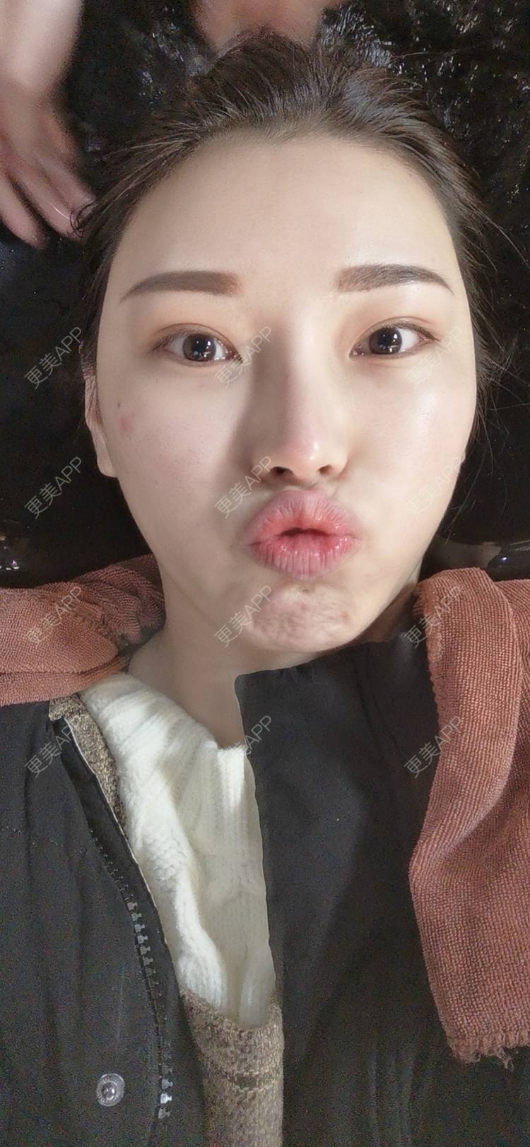 更美 - 更美用户82701801的隐形牙齿矫正经验 | 杭州