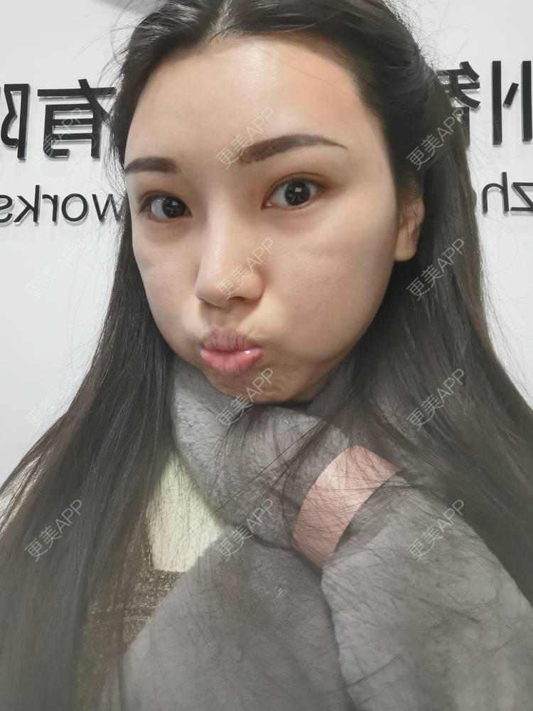 更美 - 更美用户82701801的隐形牙齿矫正经验 | 杭州