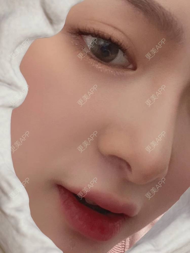 更美 - 直播听众朋友的鼻部多项经验 | 成都 | 视频日记 | 鼻部多项