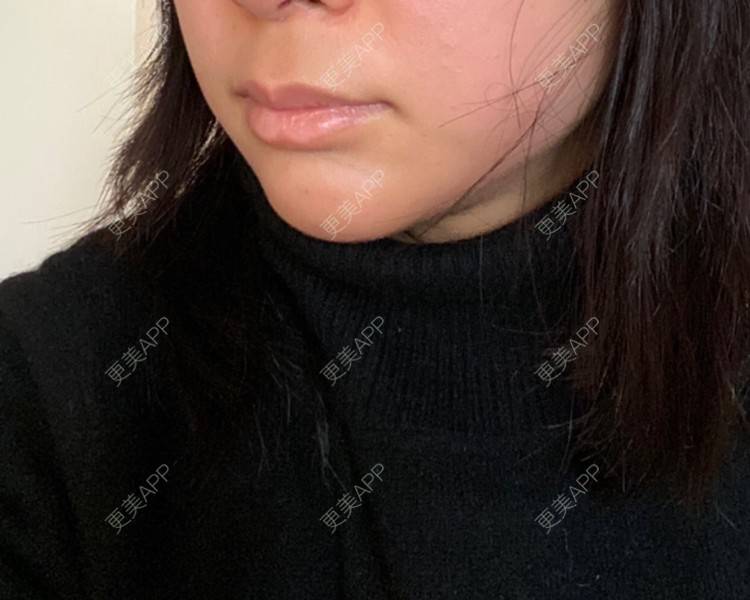 更美 - 更美用户8l1O3VgTkN的射频提升经验 | 武汉 | 射频提升