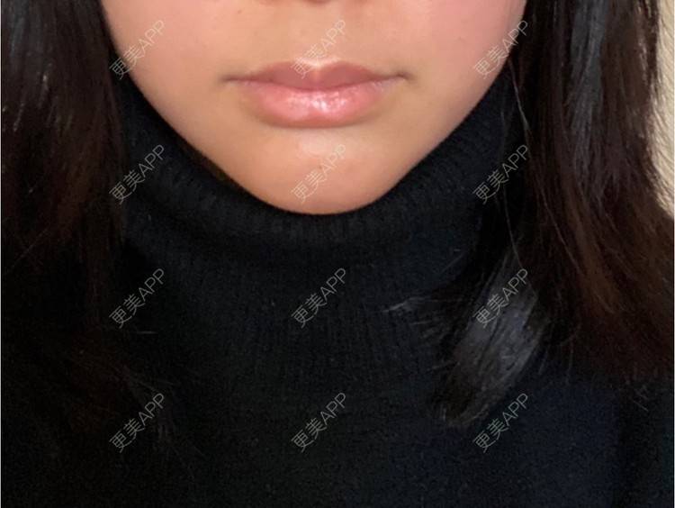 更美 - 更美用户8l1O3VgTkN的射频提升经验 | 武汉 | 射频提升