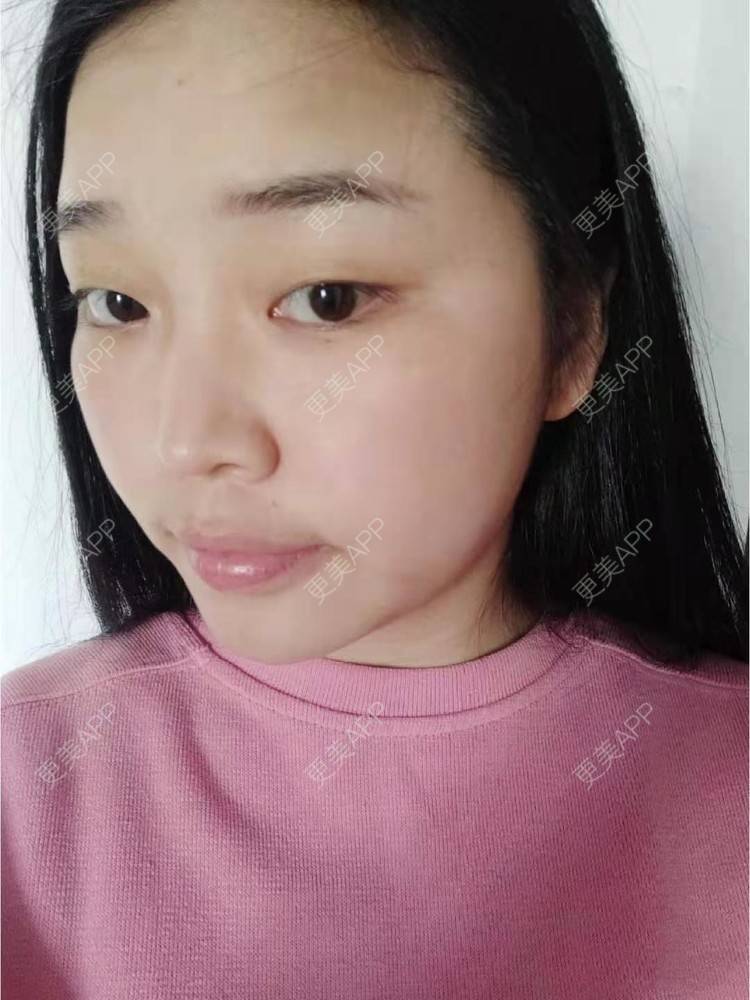 更美 - 更美用户8Ikm7F69MT的改善动态纹经验 | 改善动态纹 | 上海 | 改善面部细纹
