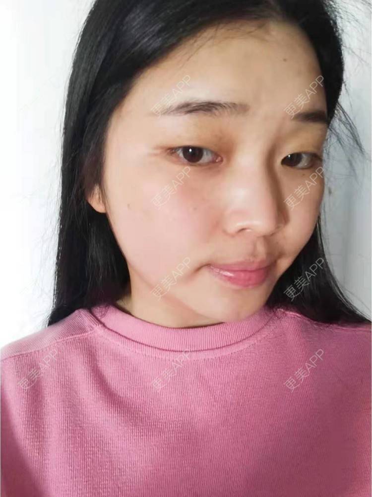 更美 - 更美用户8Ikm7F69MT的改善动态纹经验 | 改善动态纹 | 上海 | 改善面部细纹