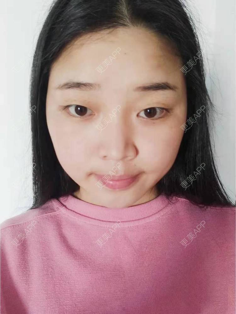 更美 - 更美用户8Ikm7F69MT的改善动态纹经验 | 改善动态纹 | 上海 | 改善面部细纹