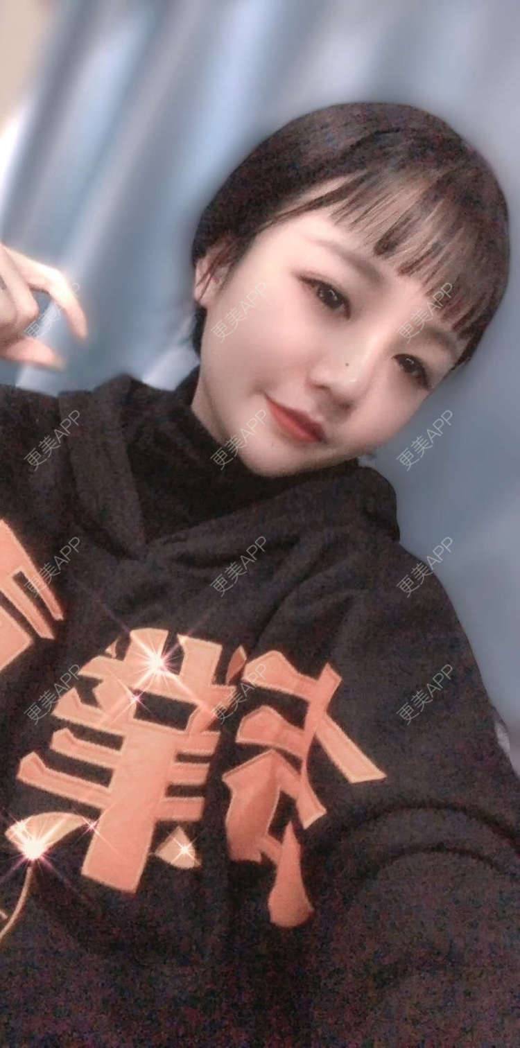 更美 - ALittle芸豆的隆鼻经验 | 鼻部多项 | 隆鼻 | 广州