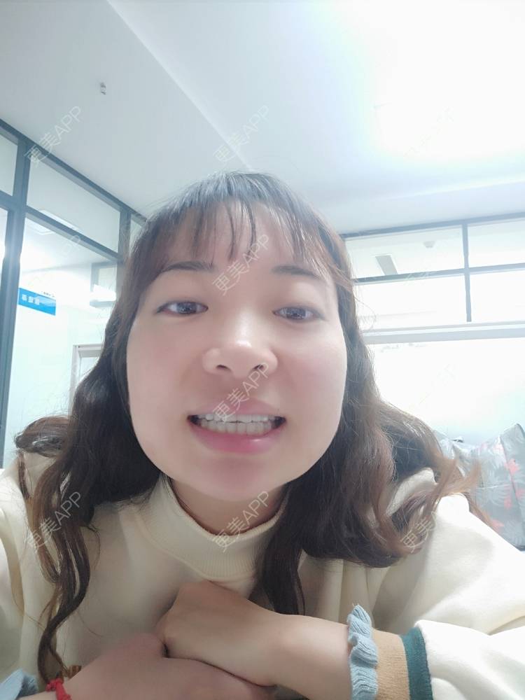 更美 - 橙子Jiang的牙齿矫正经验 | 牙齿矫正 | 成都