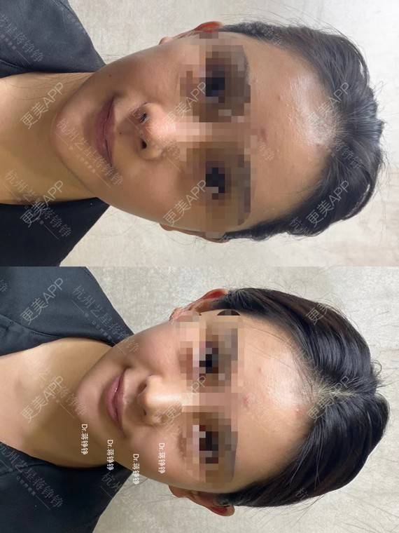 更美 - 蒋铮铮 医生的玻尿酸全面部经验 | 更美研究所 | 玻尿酸全面部 | 杭州