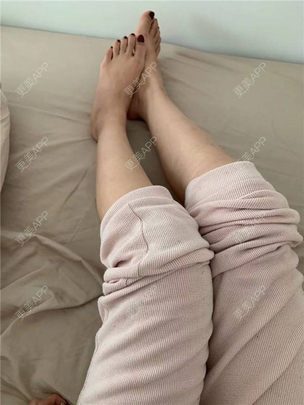 更美 - 更美用户fMcUThtw9t的超声溶脂经验 | 超声溶脂