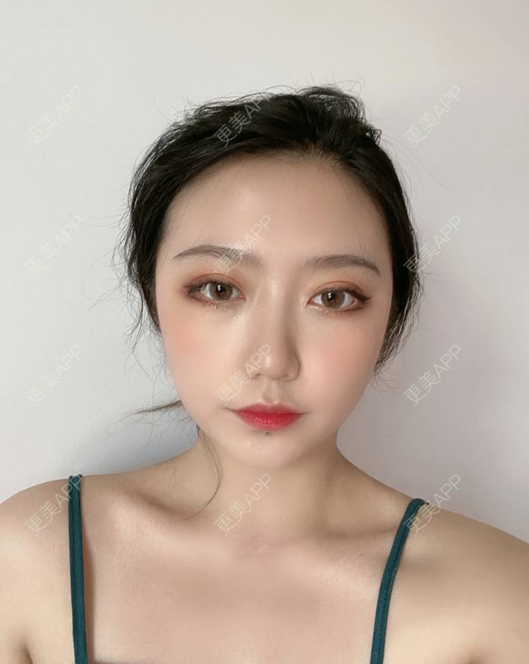 更美 - 囧妹子腺的经验 | 更美研究所 | 注射淡疤 | 激光淡疤 | 成都