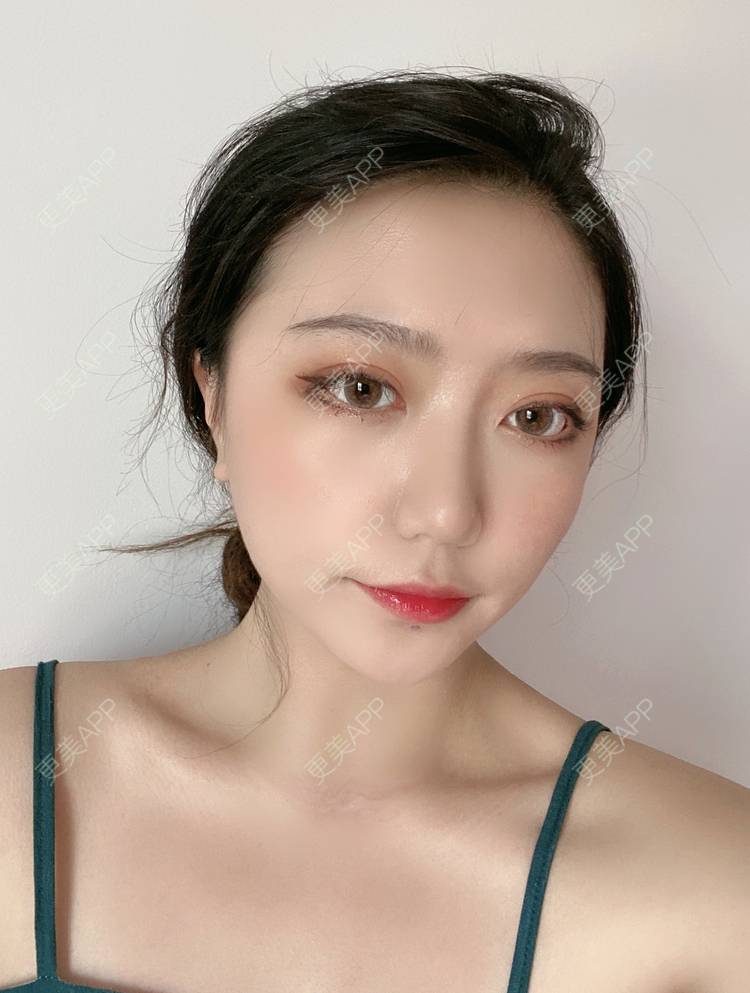 更美 - 囧妹子腺的经验 | 更美研究所 | 注射淡疤 | 激光淡疤 | 成都