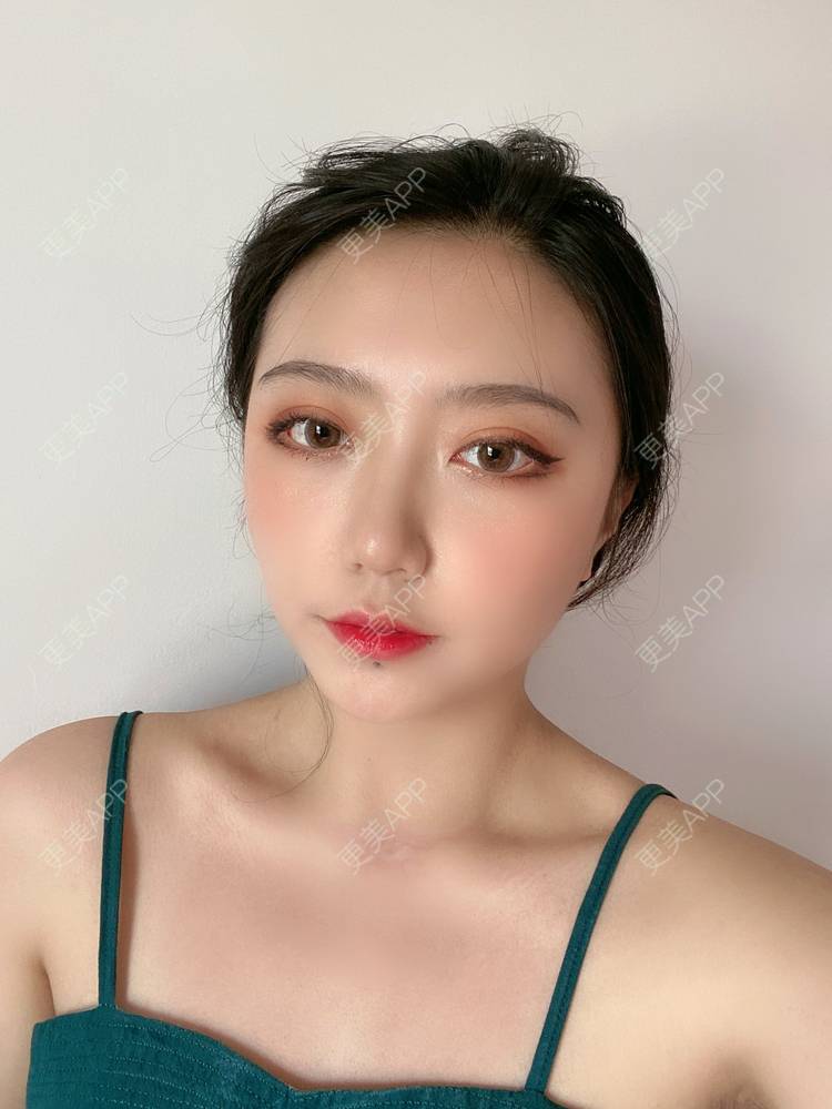 更美 - 囧妹子腺的经验 | 更美研究所 | 注射淡疤 | 激光淡疤 | 成都