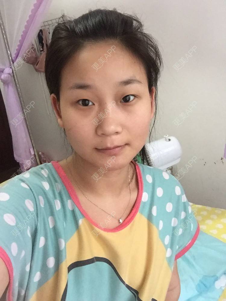 更美 - 一抹花色的双眼皮经验 | 双眼皮 | 重庆